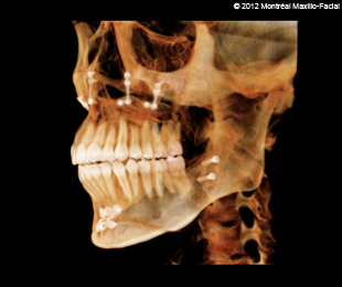 Marie-Hélène Cyr - Scan 3D (profil gauche à 45 degrés) après des traitements d'orthodontie et des chirurgies orthognatiques (13 février 2012)